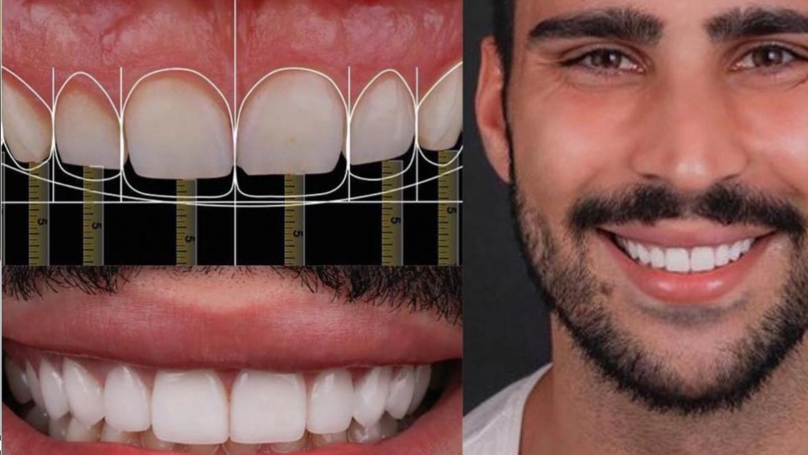 How Does The Smile Design Process Look Like?